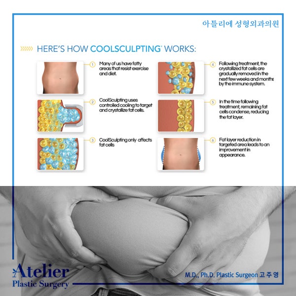 수술이 부담스럽다면 쿨스컬프팅으로 슬림하게 사진 5