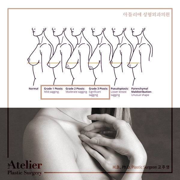 출산 후, 수유, 체중감소로 가슴처짐이 고민이라면