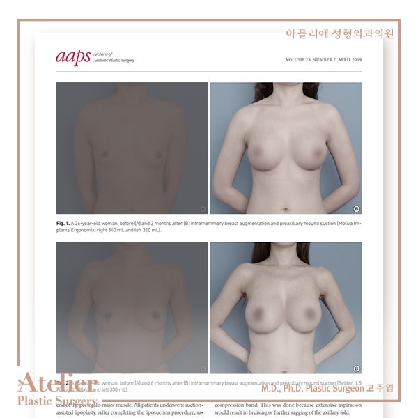 부유방제거 수술과 시술 중에서 고민한다면 사진 8