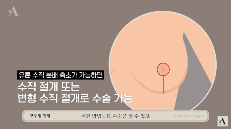 가슴 수술의 모든 것, < 가슴 축소 수술 > 2탄 사진 2