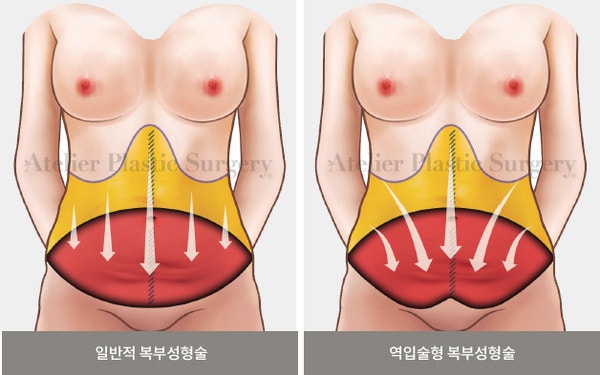 방배동 성형외과, 처진 뱃살 개선 과 복부 성형수술