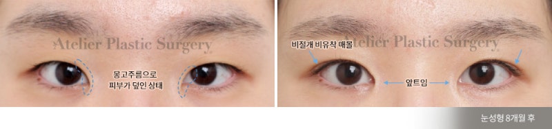 서래마을 성형외과, 아틀리에 성형외과 의 눈 수술 철학 사진 2
