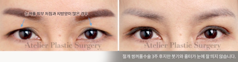 서래마을 성형외과, 아틀리에 성형외과 의 눈 수술 철학 사진 5