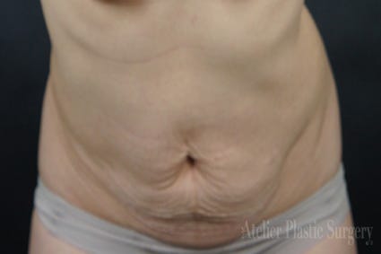 복부성형 + 배꼽성형 으로 자신있게 크롭티 입어볼까?