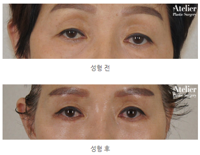 눈꺼풀 무거움을 느낄때는? 눈매교정술!