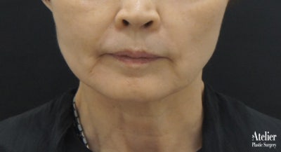 보형물이 필요없는 턱끝성형 사진 3
