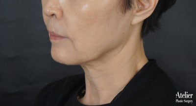 보형물이 필요없는 턱끝성형