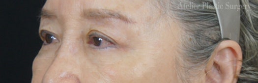 중년인기성형 '하안검+눈썹하거상' 성형 후기 사진 5