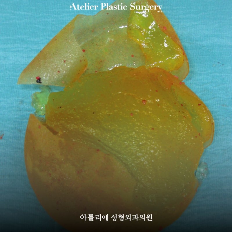 역삼역 성형외과 가슴보형물터짐 증상 발생 과정 정리