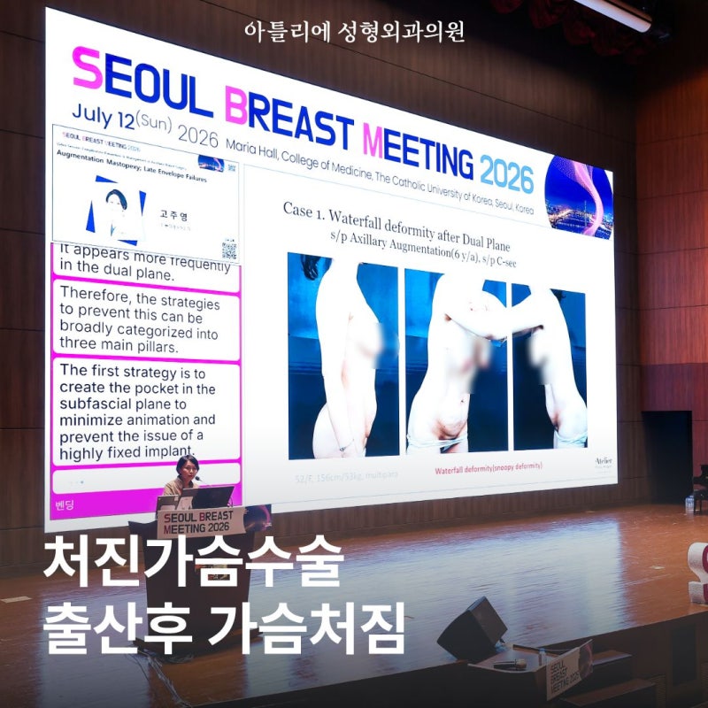 처진가슴수술 출산후 모유수유 가슴처짐 고민이라면