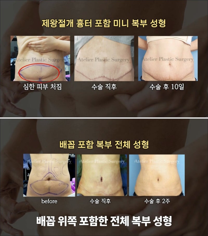 제왕절개 후 복부성형 출산후 복직근 뱃살처짐 개선할 수 있을까? 사진 2
