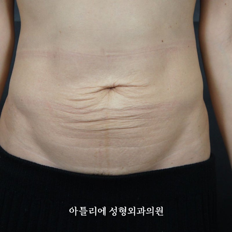 처진살 수술 복부거상 흉터 후기 찾고 있다면 확인하세요 사진 7