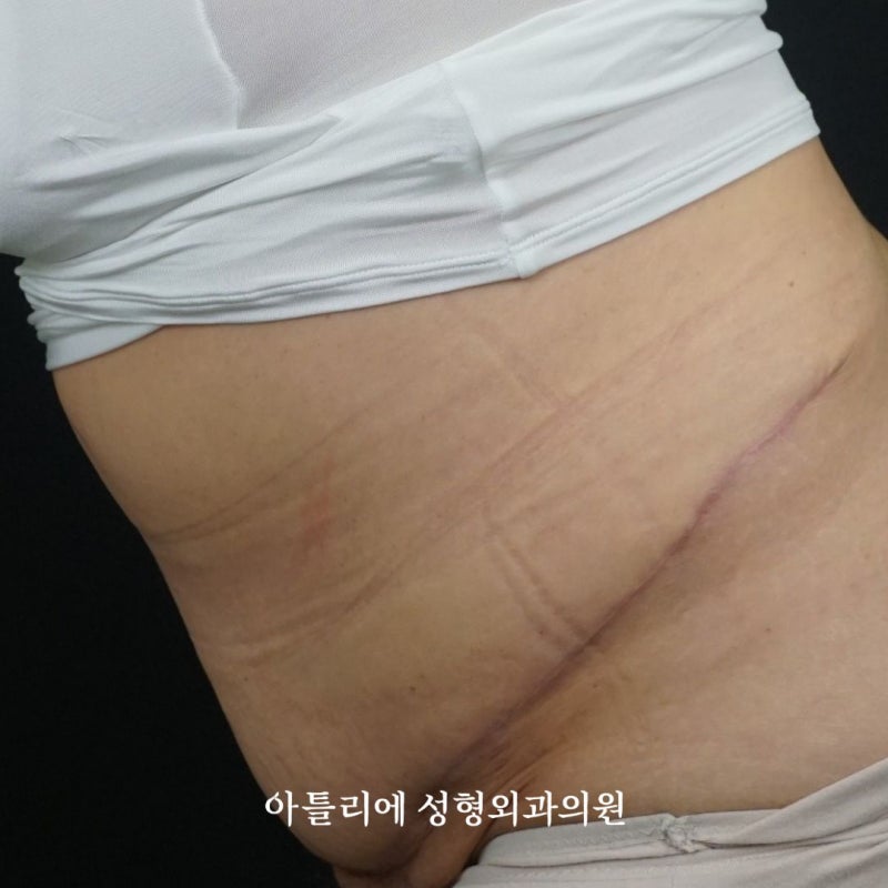 처진살 수술 복부거상 흉터 후기 찾고 있다면 확인하세요 사진 6