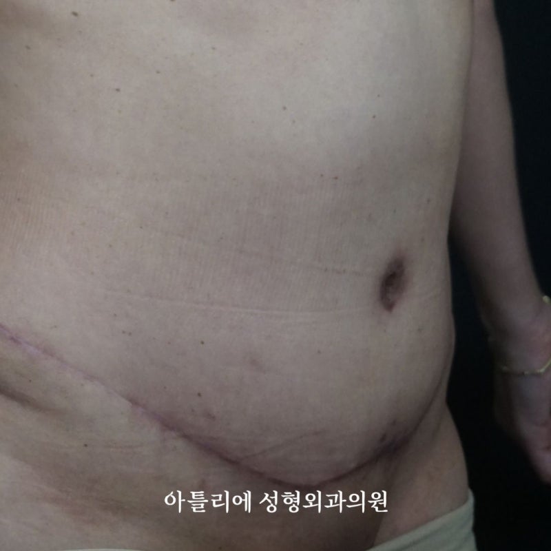처진살 수술 복부거상 흉터 후기 찾고 있다면 확인하세요 사진 5