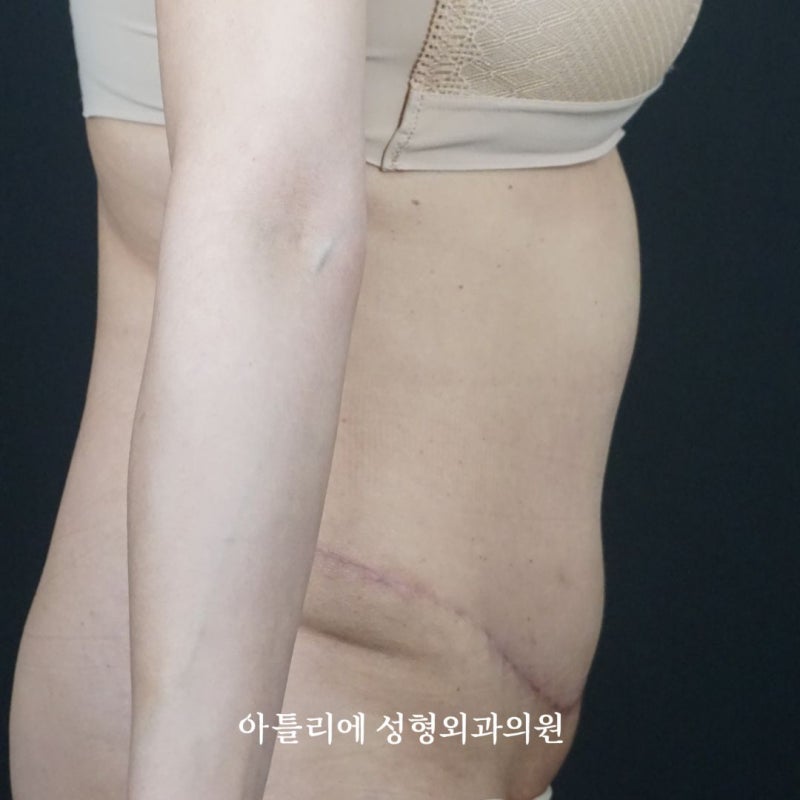 처진살 수술 복부거상 흉터 후기 찾고 있다면 확인하세요 사진 3