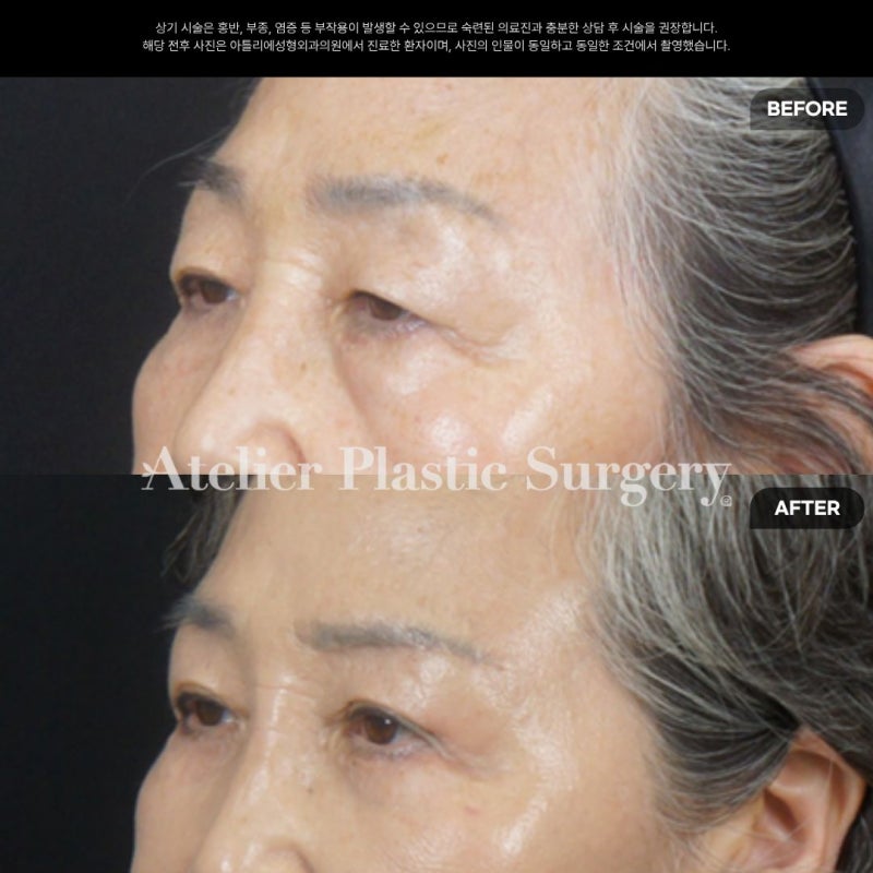 눈썹하거상 흉터 후기 비용 비절개 눈매교정 중년눈성형잘하는곳 확인하세요 사진 4