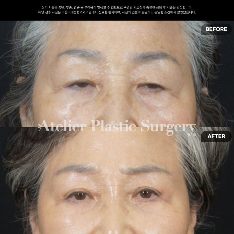 눈썹하거상 흉터 후기 비용 비절개 눈매교정 중년눈성형잘하는곳 확인하세요 사진 3